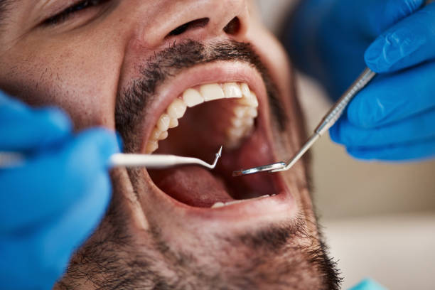 Best Emergency Tooth Extraction in Cleves, OH